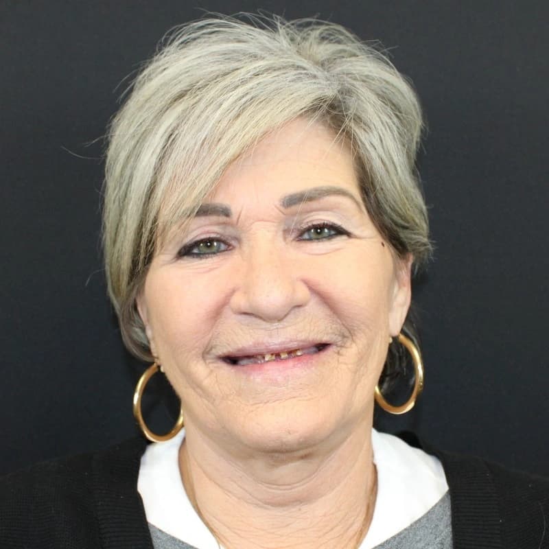Pamela before dental implants