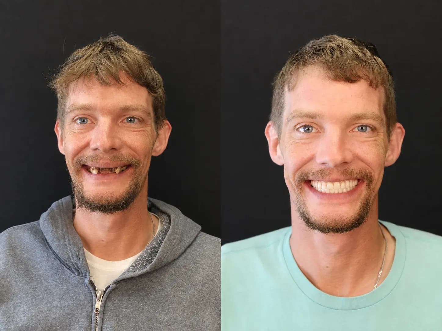 Full Mouth Dental Implants Before and After: Terry’s Smile Journey