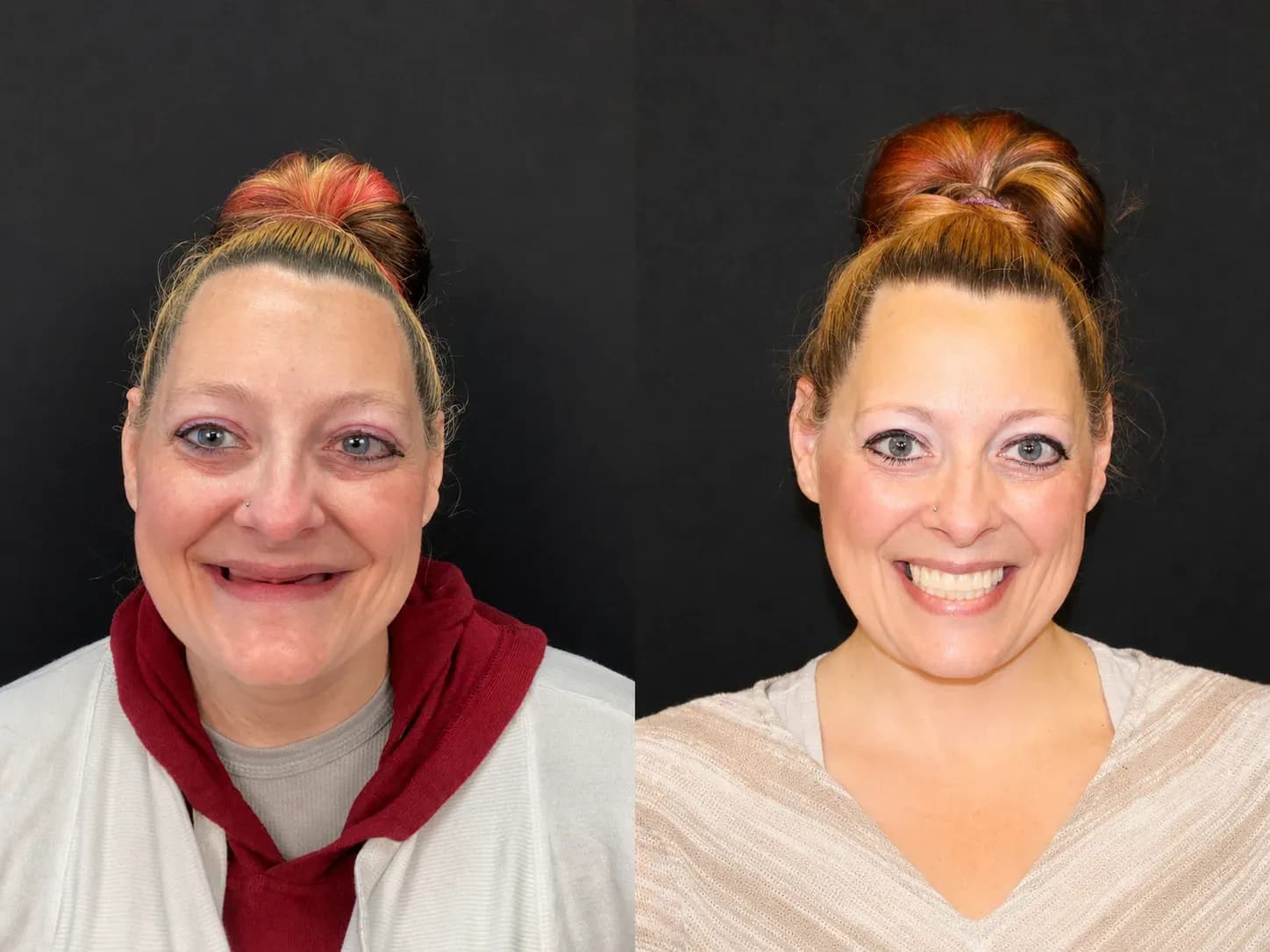 Full Mouth Dental Implants Before and After: Kristen’s Smile Journey