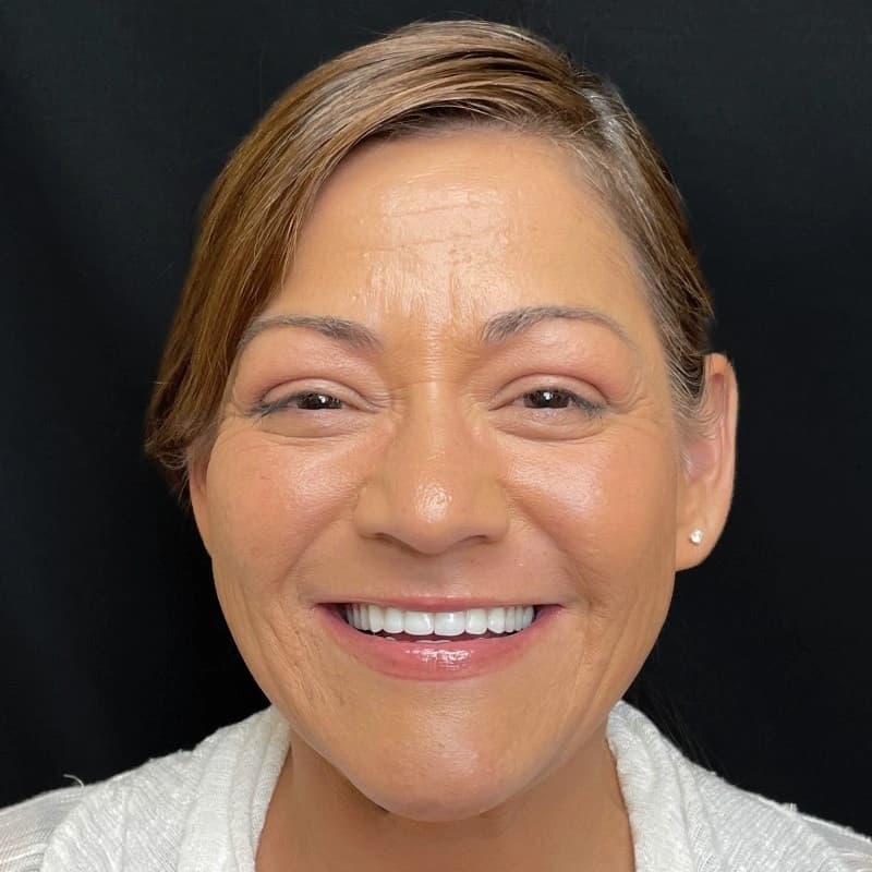 SPG dental implant patient smiling after treatment